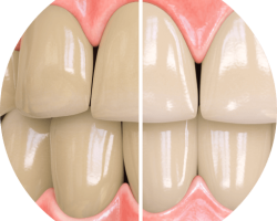 تاثیر خمیردندان Opalescence بر لکه های سطحی دندان ها و سفیدکردن تا دو درجه
