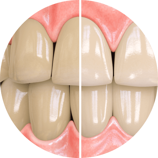 تاثیر خمیردندان Opalescence بر لکه های سطحی دندان ها و سفیدکردن تا دو درجه